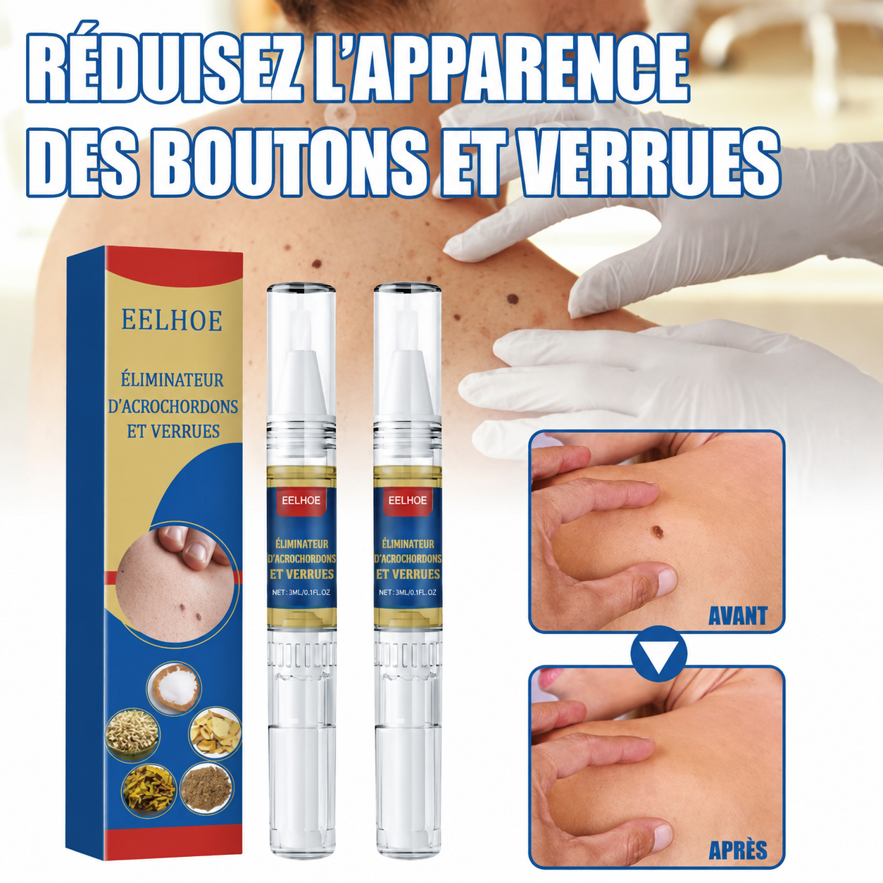 Le stylo qui efface verrues et accrocheurs sans douleur ni médecin